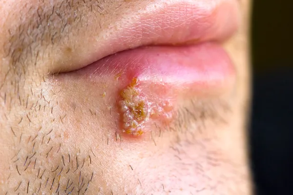 Cold sores (herpes labialis)