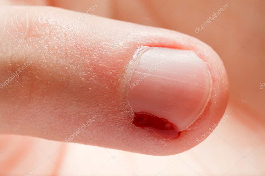 nail wound