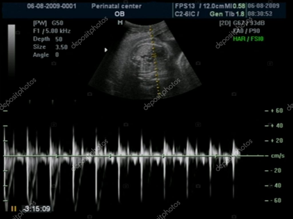 Ultrasound Heart