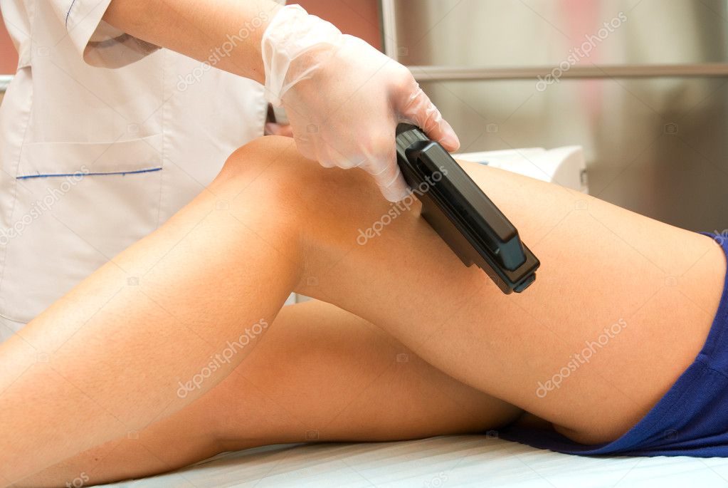 laser epilation