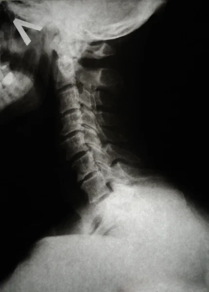 Detail of neck and part of head x-ray