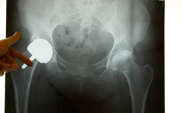 X-ray of a Hip Prosthesis