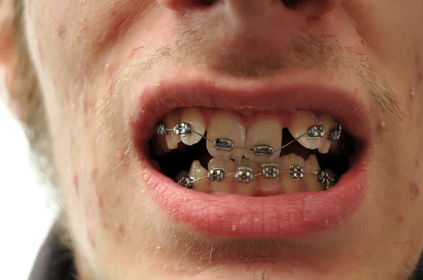 Close up of crooked teeth with braces