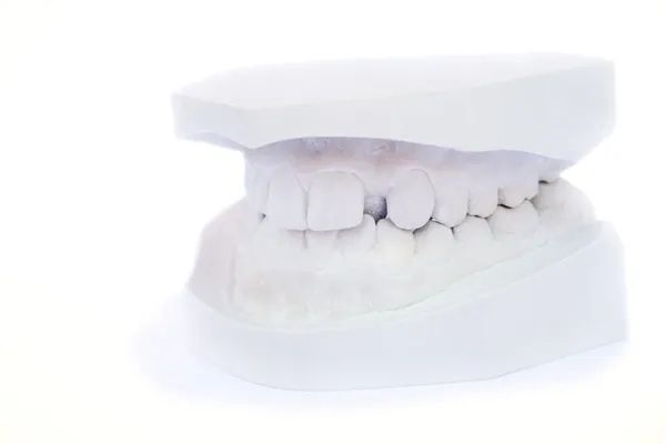 stock image Teeth gypsum model