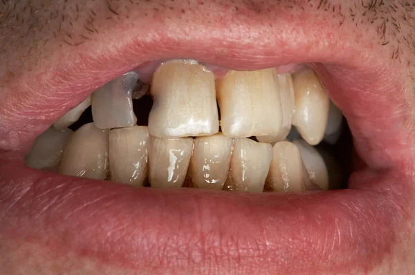 Δόντι άρρωστος — Φωτογραφία Αρχείου