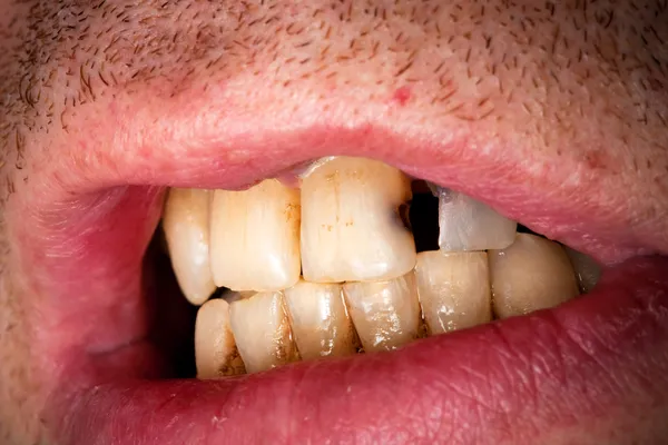 Στόμα Του Άντρα Άρρωστο Δόντι — Φωτογραφία Αρχείου