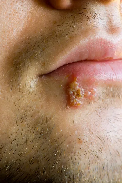 stock image Cold sores (herpes labialis)