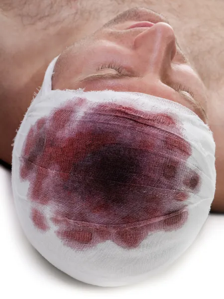 Ligadura na cabeça da ferida sanguínea — Fotografia de Stock