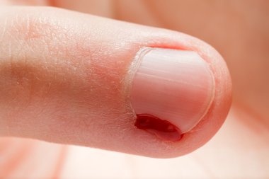 Blood wound finger nail clipart