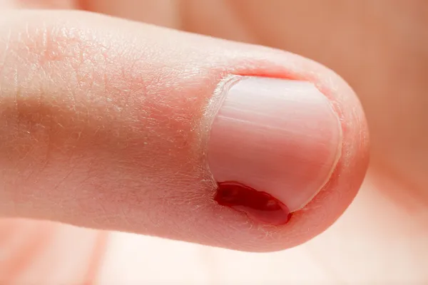 Blod sår finger spik — Stockfoto