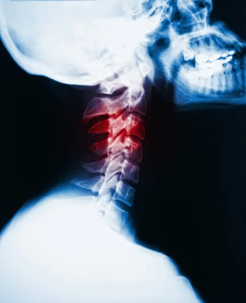Raio-X do pescoço e dor — Fotografia de Stock