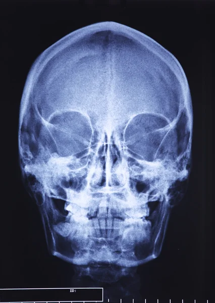 Radiographie du crâne — Photo