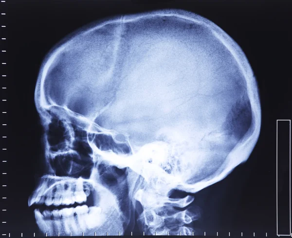 Рентген черепа — стоковое фото