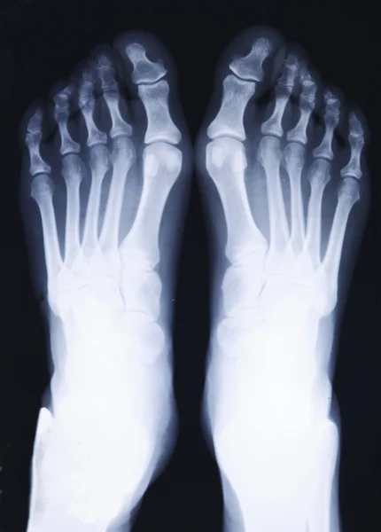 Raio-x dos pés — Fotografia de Stock