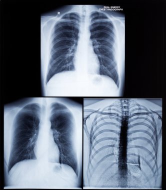 İnsan Göğsünün X-Ray Görüntüsü