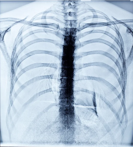 X-Ray Afbeelding van de menselijke borst — Stockfoto
