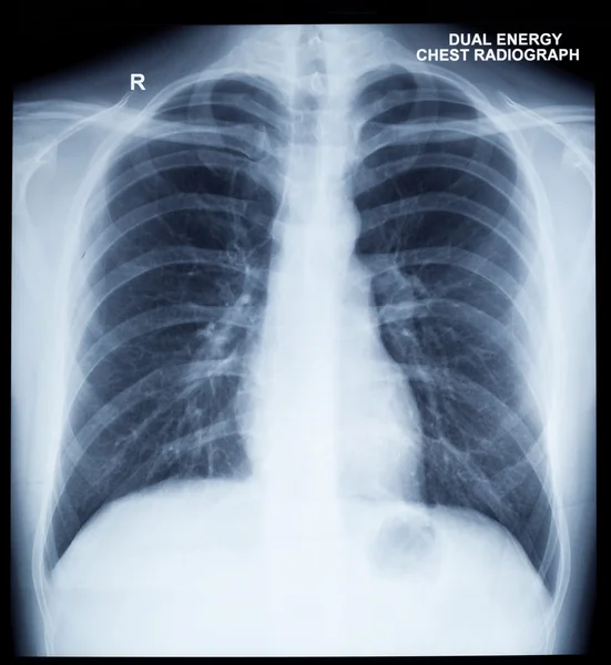 X-Ray Image Of Human Chest — Stock Photo, Image