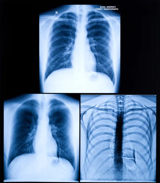 Immagine a raggi X del petto umano — Foto Stock