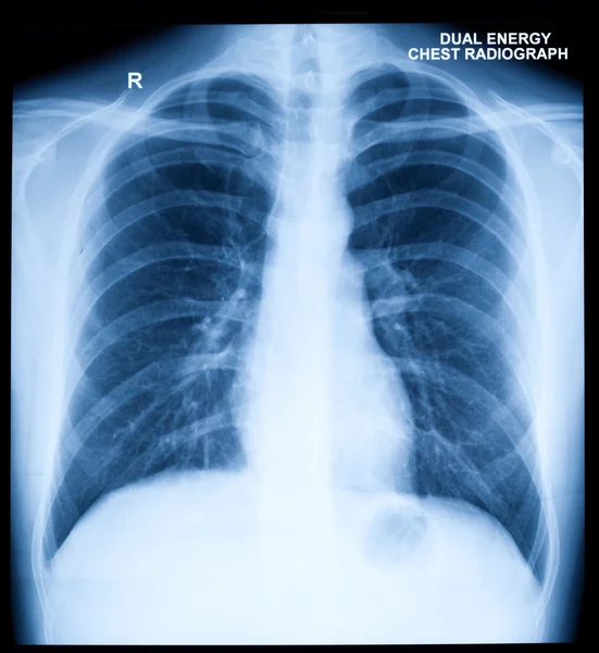 stock image X-Ray Image Of Human Chest