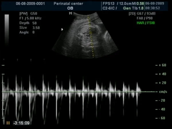 Kalp Hızını Gösteren Bir Gebelik Ultrason Taraması — Stok fotoğraf