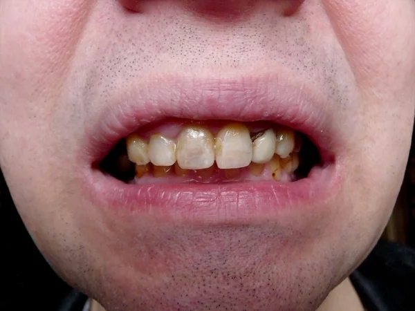 Bad teeth — Stock Photo, Image