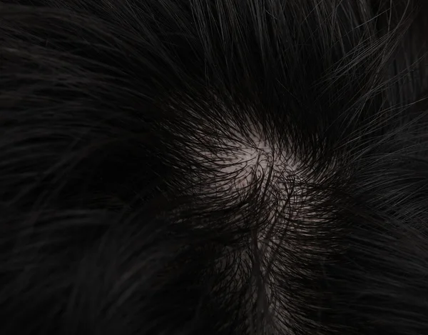 Волосся молодого чоловіка з випаданням волосся — стокове фото
