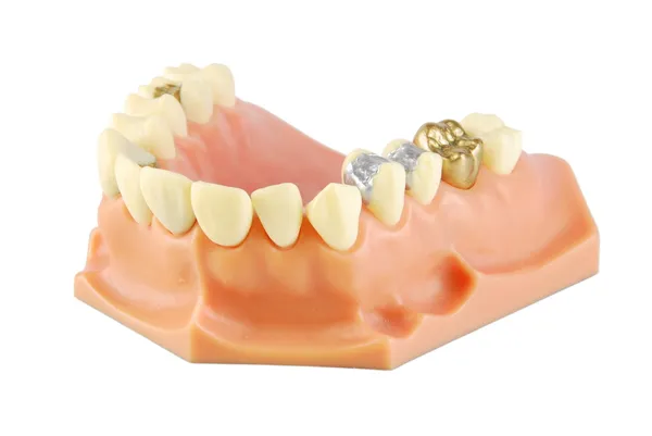 Zahnmodell (mit unterschiedlichen Behandlungen)) — Stockfoto
