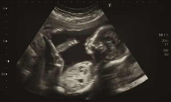 Análisis ultrasonográfico de un feto de cuarto mes —  Fotos de Stock