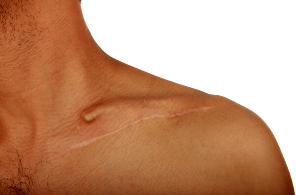 Man's shoulder with a scar from operation