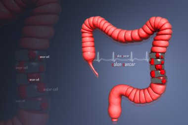 Colon cancer clipart