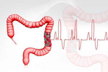 Colon cancer clipart