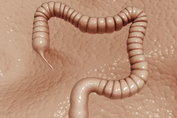 結腸がん — ストック写真