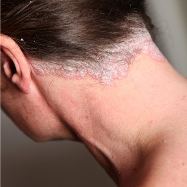 Severe psoriasis - neck , close-up clipart