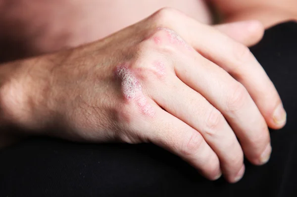 Súlyos psoriasis - pikkelysömör a kezét - közelről — Stock Fotó