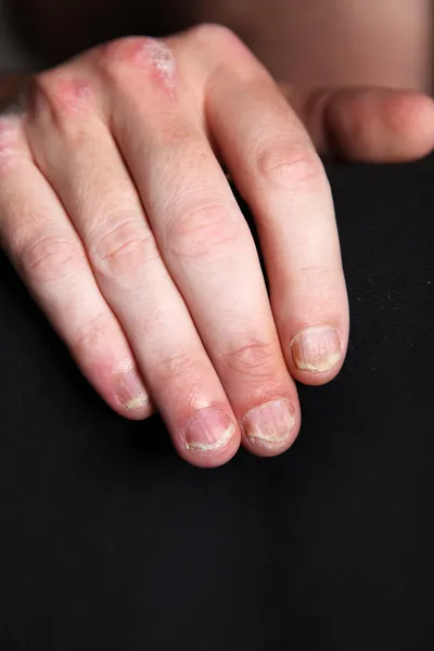 Nahaufnahme 重症乾癬 乾癬の爪と手のクローズ アップ — ストック写真
