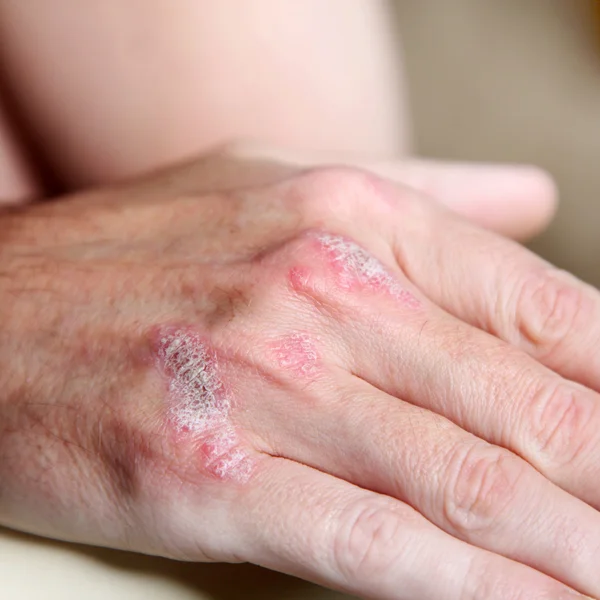 Psoriasis en los huesos de la mano - primer plano — Foto de Stock