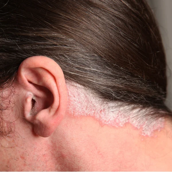 Nahaufnahme 重症乾癬 乾癬の耳や首に クローズ アップ — ストック写真