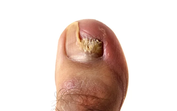 Ніготь на пальці ноги грибок — стокове фото