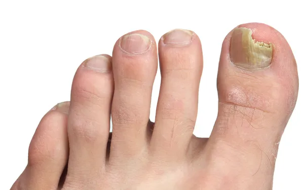 Ніготь на пальці ноги грибок на піку інфекції — стокове фото