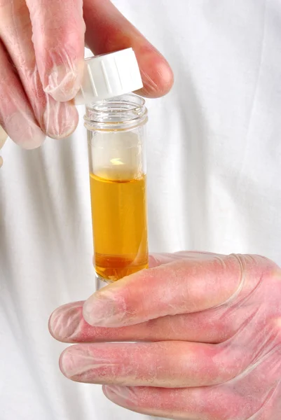 De l'urine humaine dans une bouteille d'échantillon — Photo