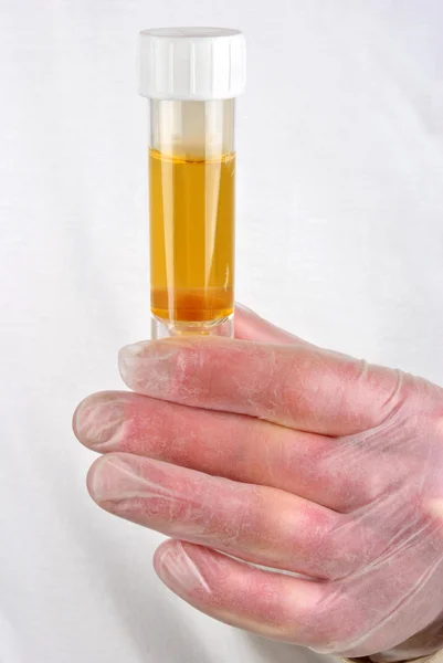 Some human urine in a sample bottle — Stock Photo, Image