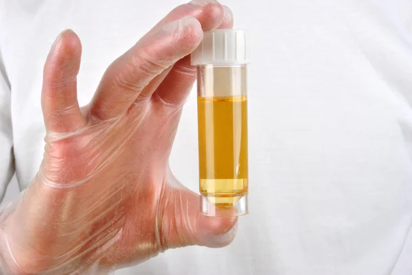 De l'urine humaine dans une bouteille d'échantillon — Photo