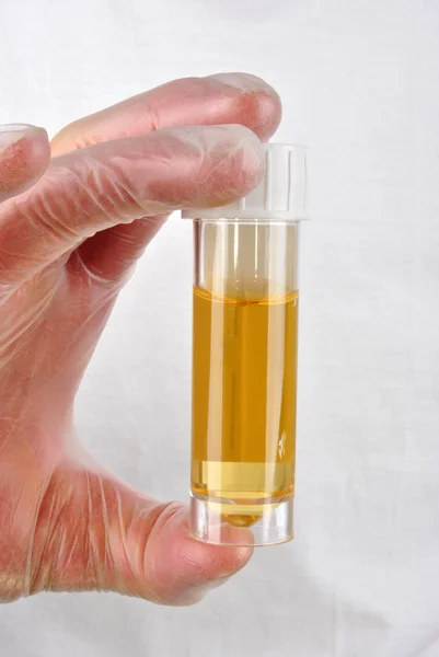Qualche urina umana in un flacone campione — Foto Stock
