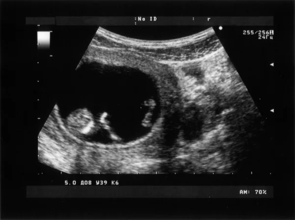 stock image Obstetric Ultrasonography of third Month Fetus