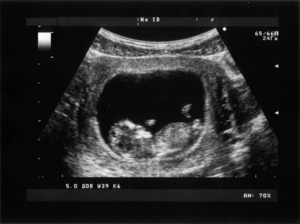 Ultrasonografía obstétrica del feto del tercer mes — Foto de Stock