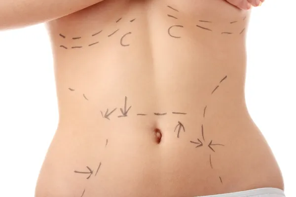 腹部贴有腹部整容手术行图案的高加索妇女腹部合影 — 图库照片
