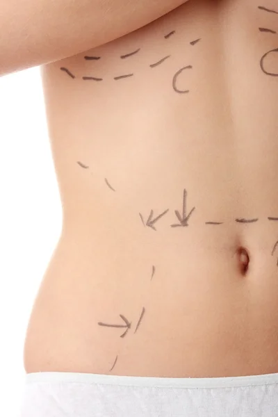 閉鎖写真の白人女性の腹部マーク付きラインのための腹部美容外科 — ストック写真