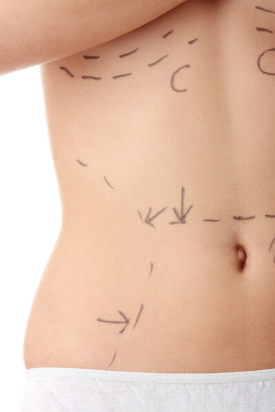 Фото крупным планом брюшной полости кавказской женщины, отмеченное линиями для косметической хирургии брюшной полости