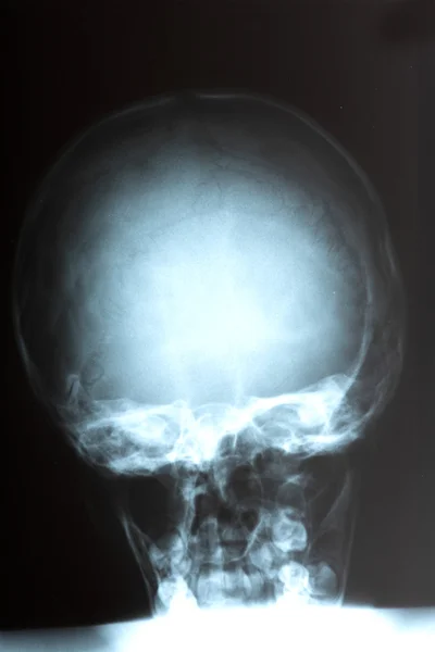 stock image Head on black and white x-ray film