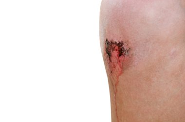 Scraped Knee clipart